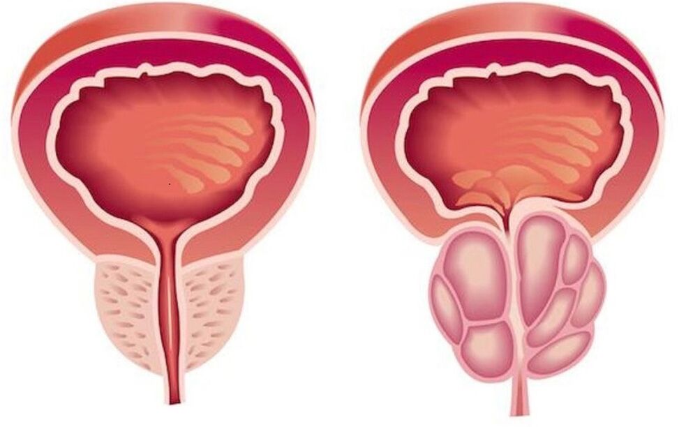 ក្រពេញប្រូស្តាតដែលមានសុខភាពល្អនិងរលាកជាមួយនឹងក្រពេញប្រូស្តាត